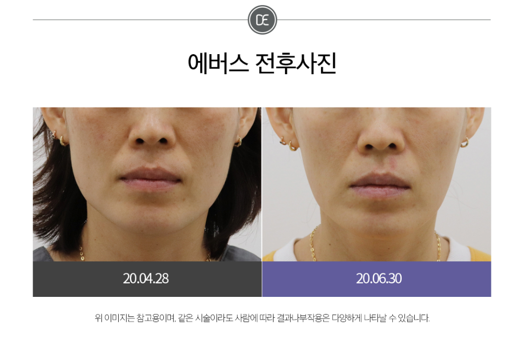 사각턱보톡스 전후 마곡피부과 닥터에버스