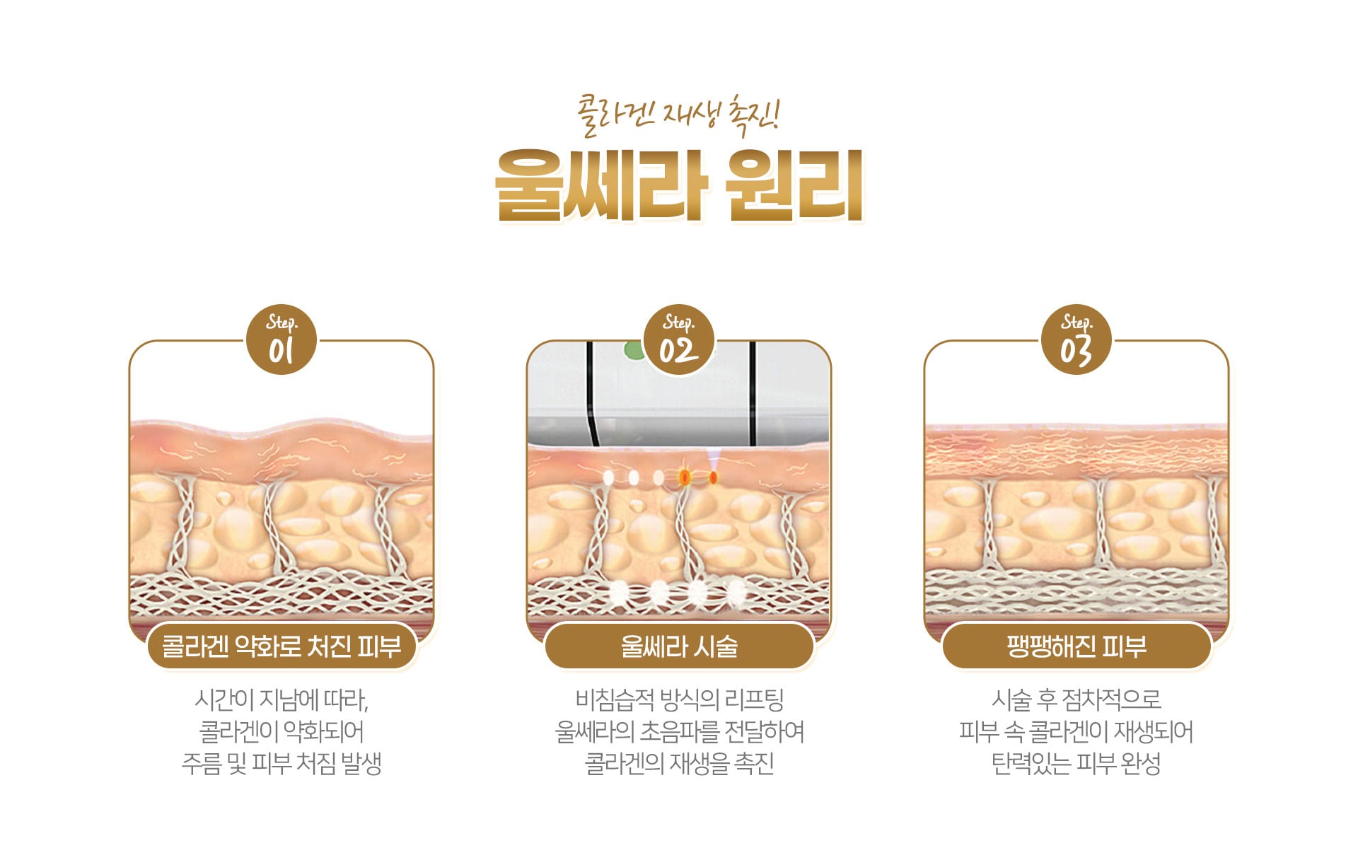울쎄라 원리 마곡피부과 닥터에버스 울쎄라 원리 마곡피부과 닥터에버스