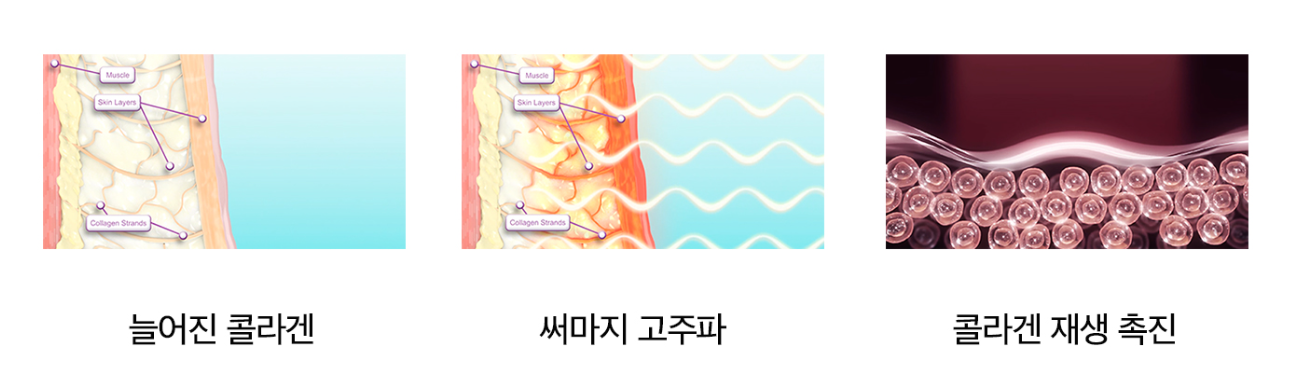 아이써마지 효과 마곡피부과 닥터에버스 아이써마지 효과 마곡피부과 닥터에버스